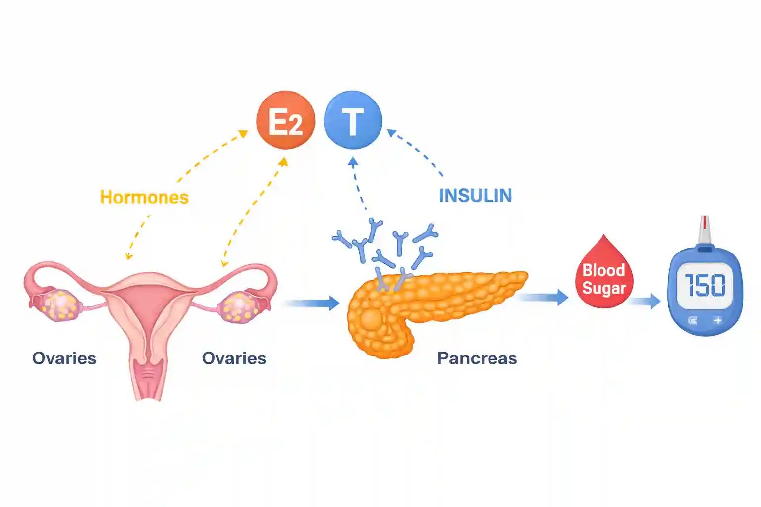 Medical illustration showing ovaries hormones insulin response and blood sugar pathways related to PCOS